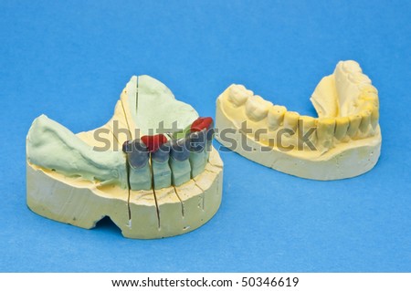 Phases of processing of a dental bridge