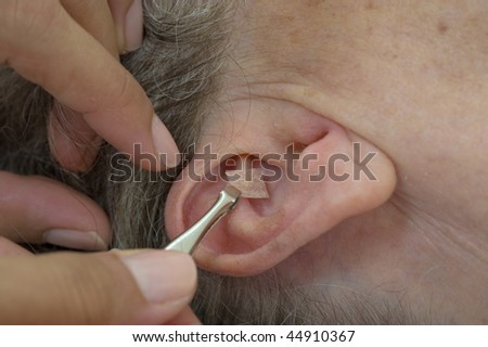 application of seed in the ear -- Auricular Seed Treatment