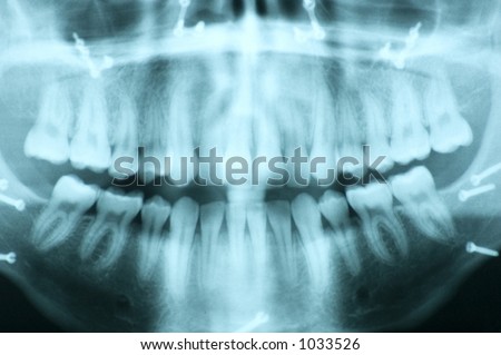 Lateral Ceph jaw x-ray showing screws used to reconstruct the jaw bones.