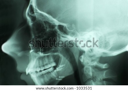 Side view head x-ray showing screws used to reconstruct the jaw bones.