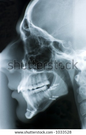 Side view head x-ray showing screws used to reconstruct the jaw bones.