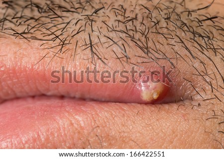 Closeup of caucasian man with mustache and pimple on upper lip