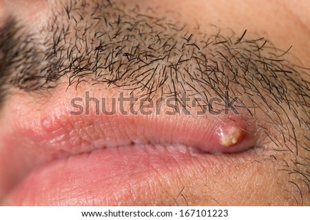 Side view of caucasian man with mustache and pimple on upper lip
