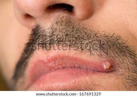 View of caucasian man with mustache and pimple on upper lip