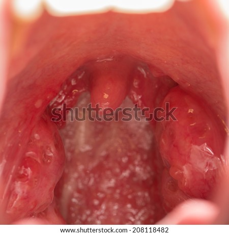 Closeup view of open mouth with tonsils