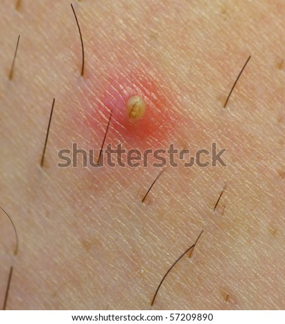 Ingrown Hair Infection. stock photo : ingrown hair