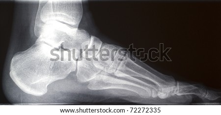 human right foot ankel xray picture (external side)
