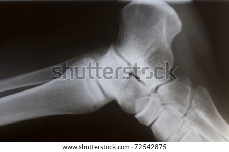 human foot ankle closeup xray