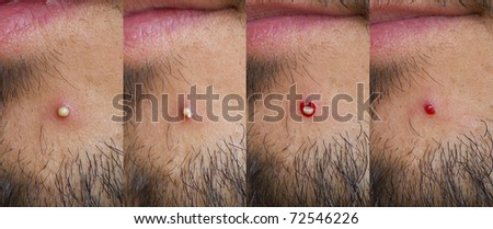 4 states pimple macro evolution over a man chin with stubble