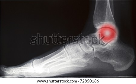 painful human right foot ankle xray picture (internal side)