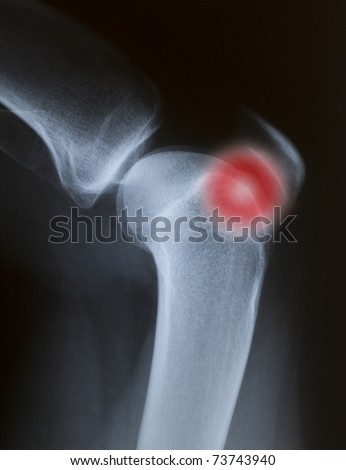 painful closeup X-ray of a knee