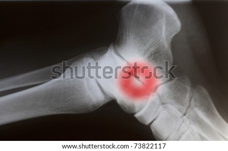 human foot ankle closeup xray with red circle focusing pain