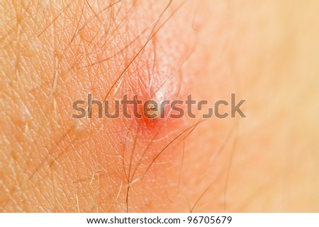 large ingrown hair