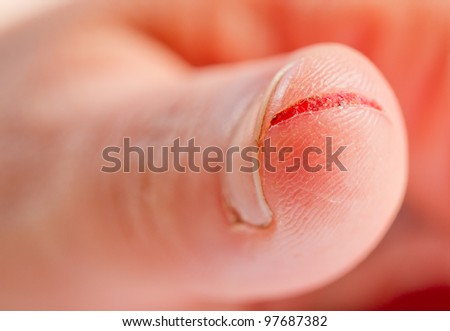 injured finger with dirty open cut
