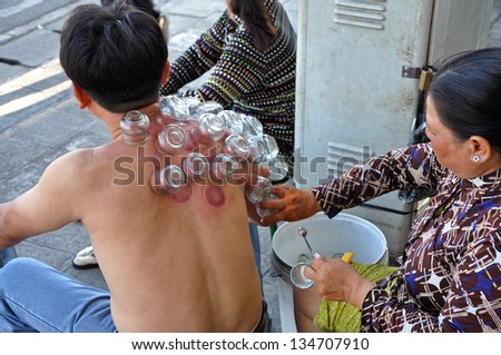 HO CHI MINH - FEB 15: Unidentified man receiving a cupping treatment in Saigon. Cupping therapy is an ancient form of Chinese alternative medicine. On Feb. 15, 2013, in Ho Chi Minh, Vietnam