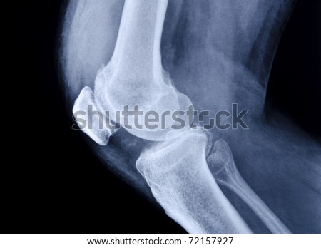 X-ray of  human knee
