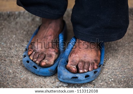 The feet of a old man who are in pain.