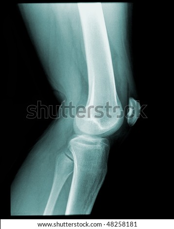 X-ray of a human knee, side view on black background