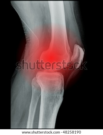 knee pain, x-ray of a human knee
