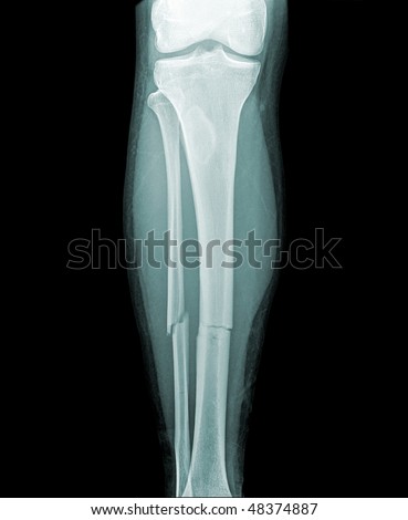 broken lower leg x-ray front view