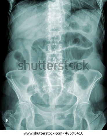 x-ray of a humen belly with lots of gas, obstruction