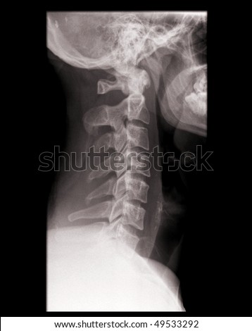 x-ray of a cervical spine isolated on black background