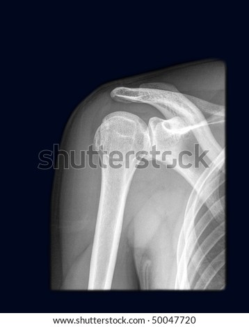 regular shoulder on x-ray