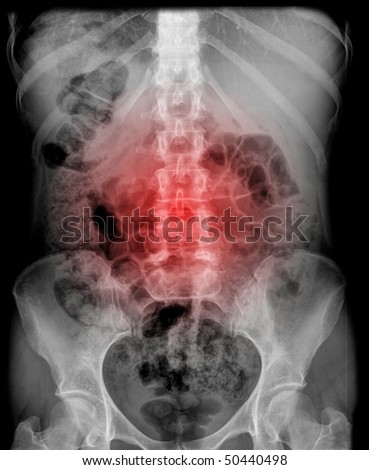 x-ray of the belly with pain