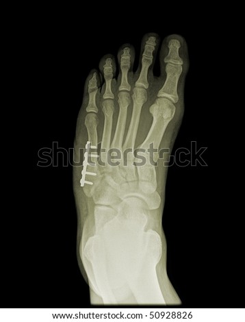 orthopedic surgery of human foot on x-ray isolated on black background