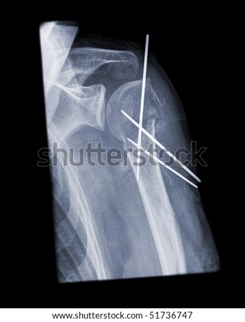 shoulder surgery, subcapital huerus fracture with k wire isolated on black background