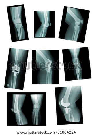 knee collection: x-ray of knee joint, replacement, different views