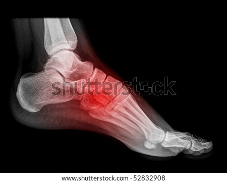 foot and ankle pain on x-ray, isolated on black background