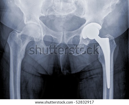 hip replacement surgery, good outcome