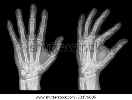 two hands skeleton on x-ray