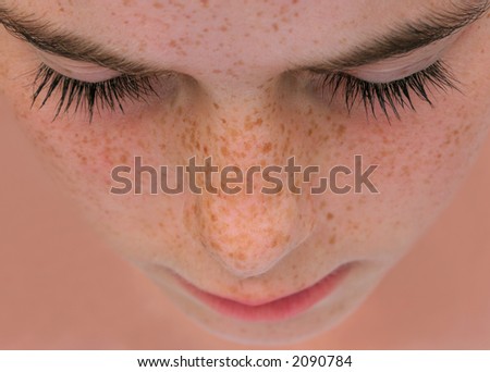 chinese freckles