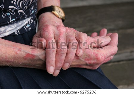 Extreme sceriosis skin disease on the hands of an elderly female.
