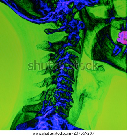 X Ray of a human spine, color enhanced.