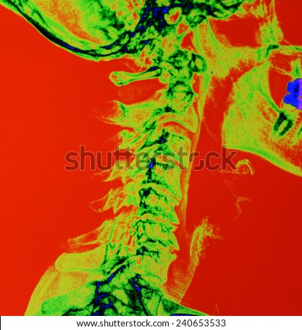 A color enhanced digital X-Ray of a human spine