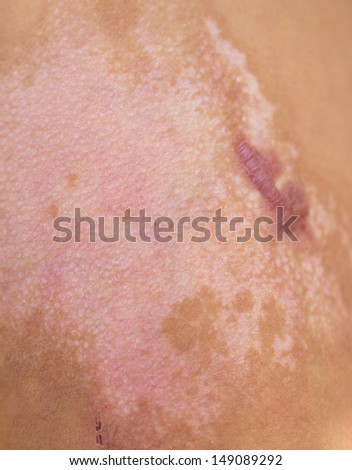 scar from a burn on the skin