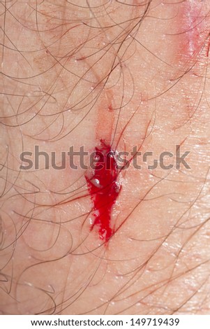 Blood from scratching the skin. macro