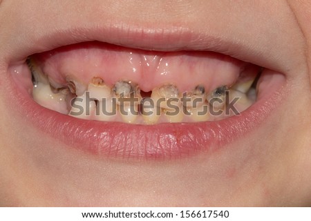 Dental medicine and healthcare - human patient open mouth showing caries teeth decay