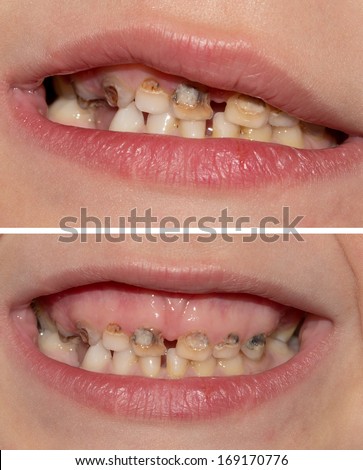 Dental medicine and healthcare - human patient open mouth showing caries teeth decay