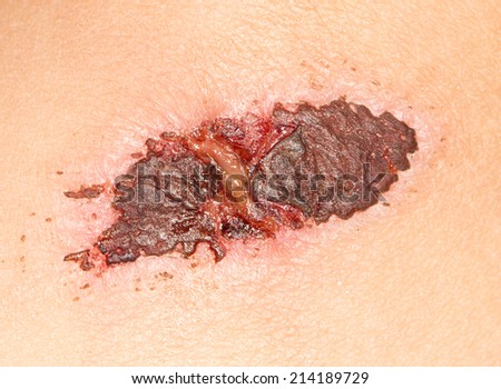 wound on the skin. close-up