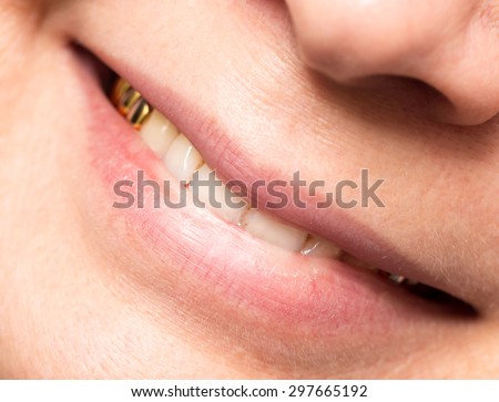 metal teeth in the mouth