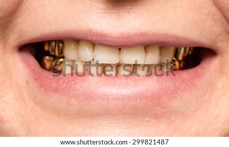 metal teeth in the mouth