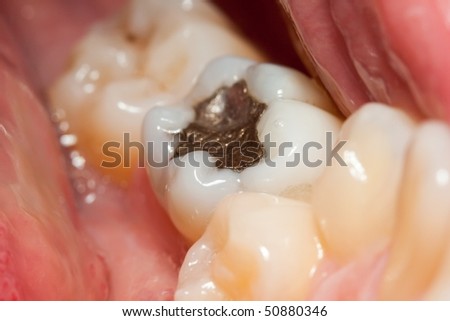Macro of a tooth with amalgam filling