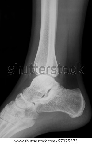 X-ray image of an ankle in the lateral position
