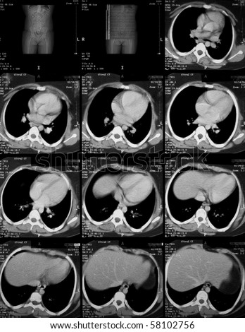 stock photo : Computed tomography (CT) of the abdomen and pelvis with IV 