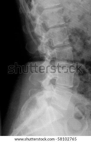 Lateral x-ray of lower back