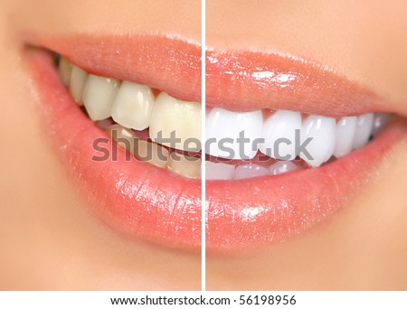 Filing+teeth+before+and+after